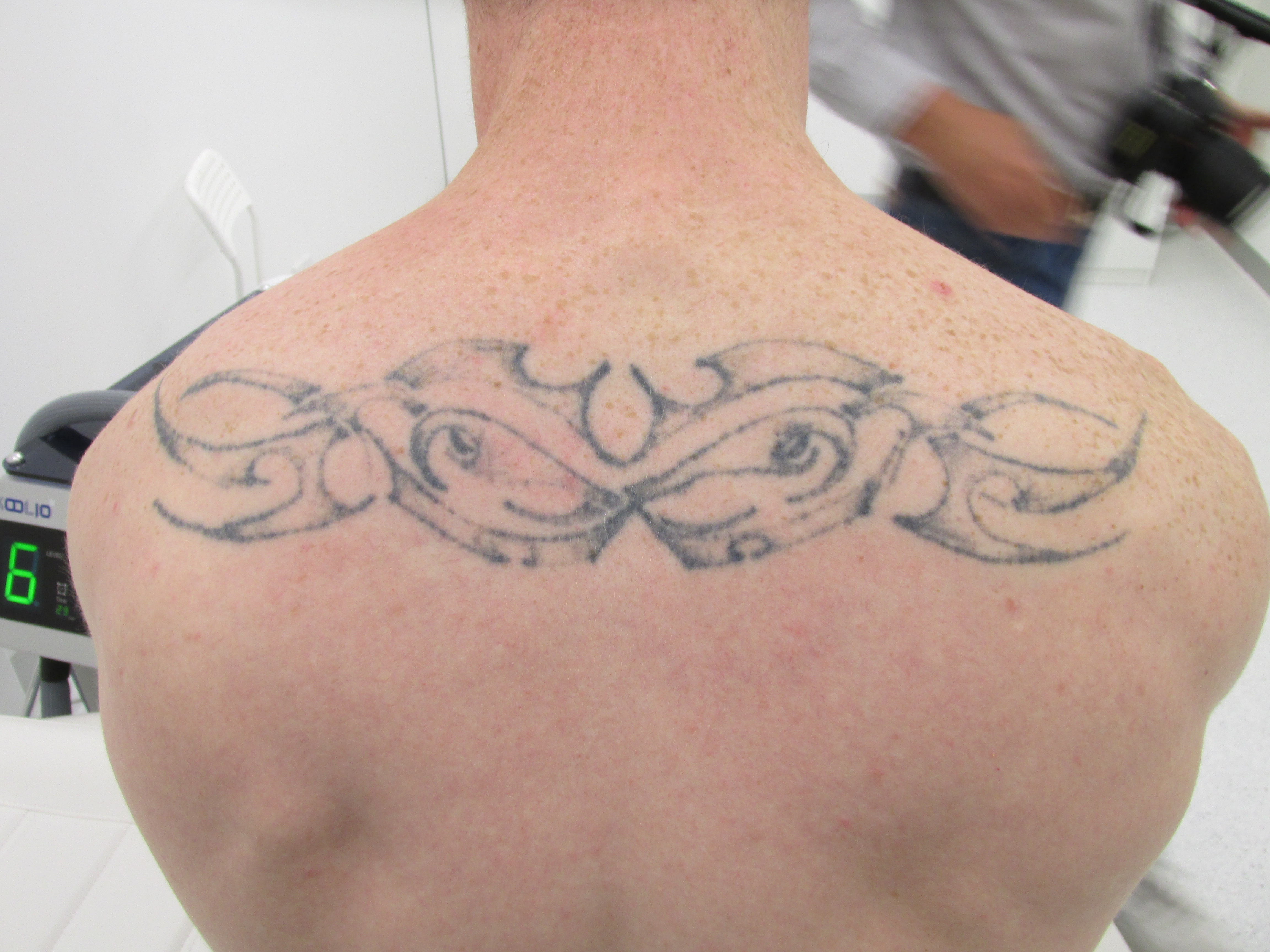 Mr B - 6 weeks after 1 treatment